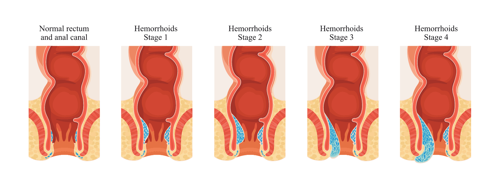 Treating Hemorrhoids Dr Bansal & Associates